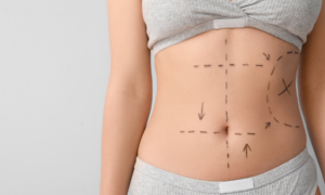 Bono PAD de Fonasa ahora cubre abdominoplastia